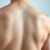 Trądzik na plecach – przyczyny, objawy i skuteczne metody leczenia