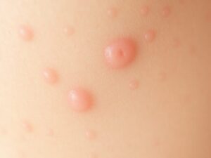Reakcja alergiczna na serum: jak rozpoznać objawy i bezpiecznie postępować w pielęgnacji skóry